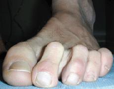 Hammertoes