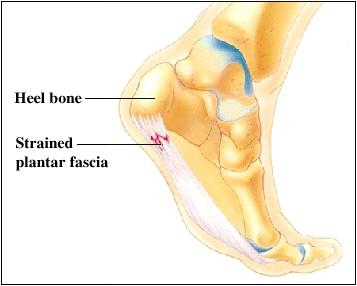 Heel Pain Treatment